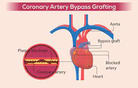 Coronary Bypass Surgery at Livasa Mohali - CABG Specialists